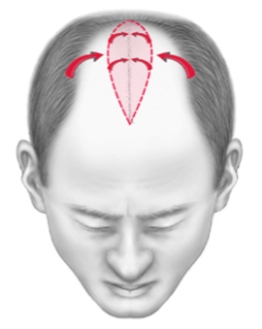 réduction de tonsure